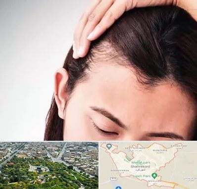 کاشت مو بانوان در شهرکرد