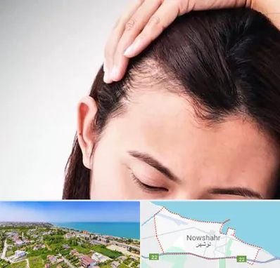 کاشت مو بانوان در نوشهر