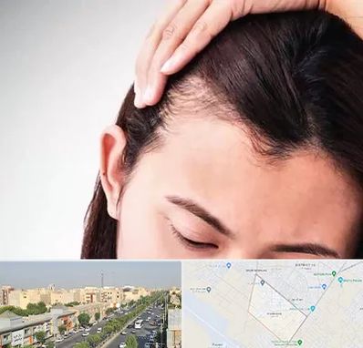 کاشت مو بانوان در کیانمهر کرج