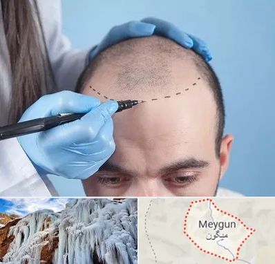 کاشت مو اقساطی در میگون