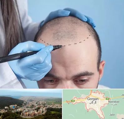 کاشت مو اقساطی در گرگان