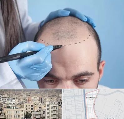 کاشت مو اقساطی در اسکندری