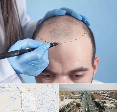 کاشت مو اقساطی در حصارک کرج