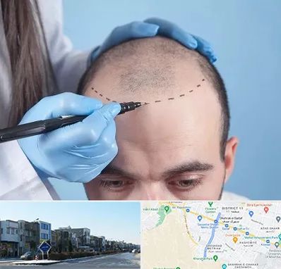 کاشت مو اقساطی در شریعتی مشهد