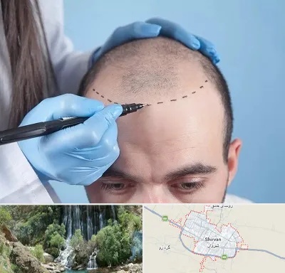 کاشت مو اقساطی در شیروان