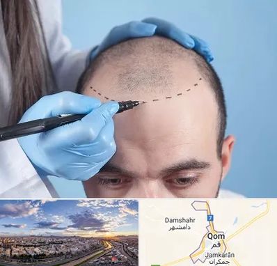 کاشت مو اقساطی در قم