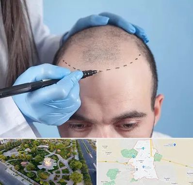 کاشت مو اقساطی در کاشمر