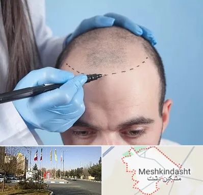 کاشت مو اقساطی در مشکین دشت