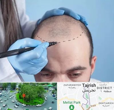 کاشت مو اقساطی در تجریش 