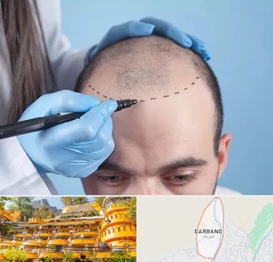 کاشت مو اقساطی در دربند