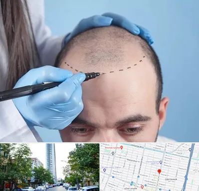 کاشت مو اقساطی در امامت مشهد