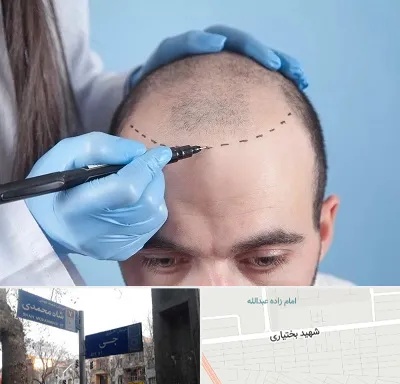 کاشت مو اقساطی در سی متری جی