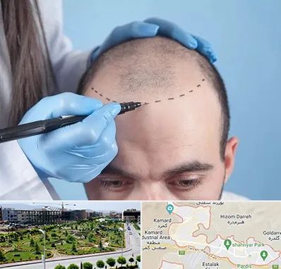 کاشت مو اقساطی در پردیس