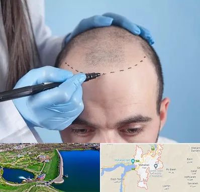 کاشت مو اقساطی در مهاباد