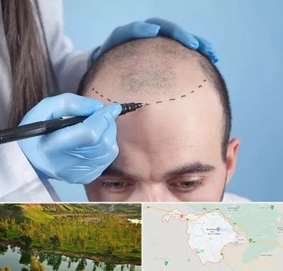 کاشت مو اقساطی در بهبهان