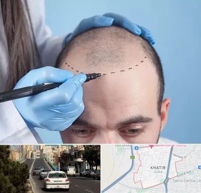 کاشت مو اقساطی در خطیب تبریز