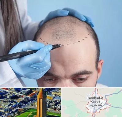 کاشت مو اقساطی در گنبد کاووس