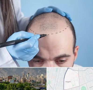 کاشت مو اقساطی در جمشیدیه