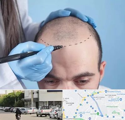 کاشت مو اقساطی در قدوسی شرقی شیراز