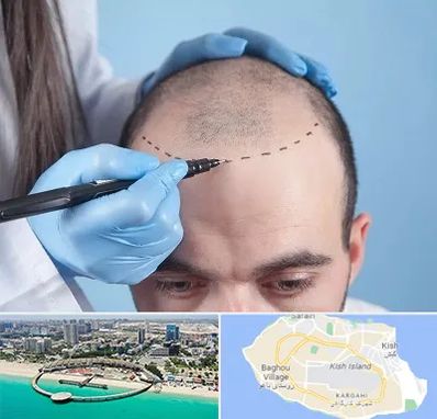 کاشت مو اقساطی در کیش