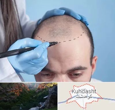 کاشت مو اقساطی در کوهدشت