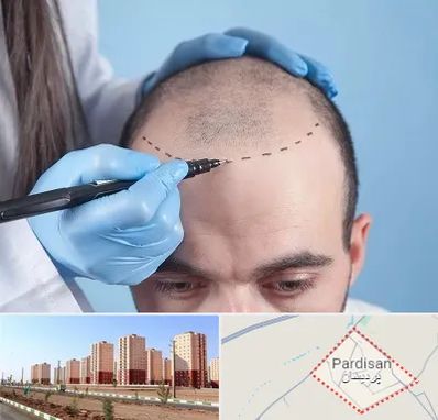 کاشت مو اقساطی در پردیسان قم