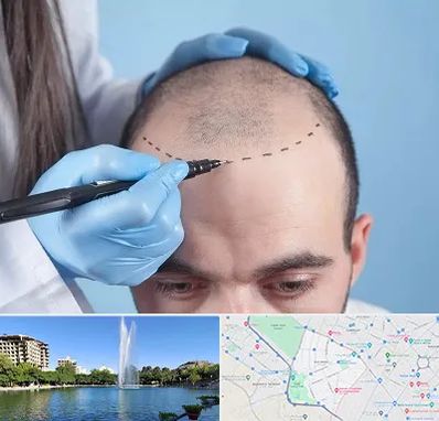 کاشت مو اقساطی در کوهسنگی مشهد