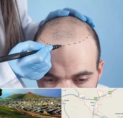 کاشت مو اقساطی در بیجار