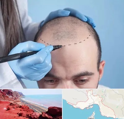 کاشت مو اقساطی در هرمزگان