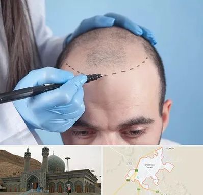 کاشت مو اقساطی در شهرضا