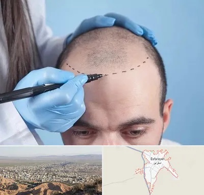 کاشت مو اقساطی در اسفراین
