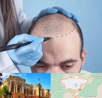 کاشت مو اقساطی در خوی