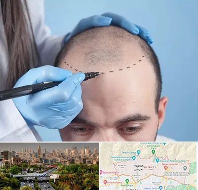 کاشت مو اقساطی در منطقه 1 تهران 