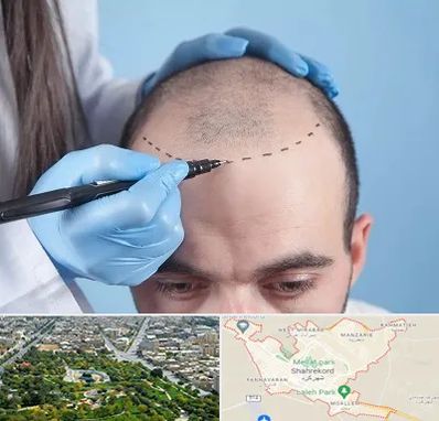 کاشت مو اقساطی در شهرکرد