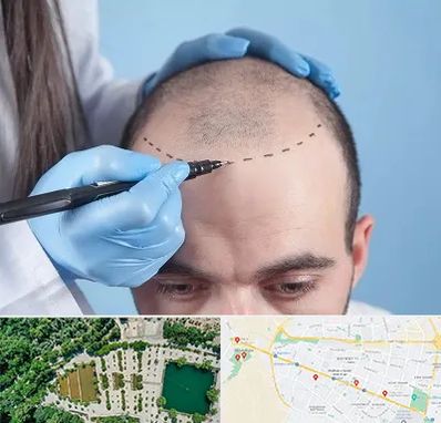 کاشت مو اقساطی در وکیل آباد مشهد 