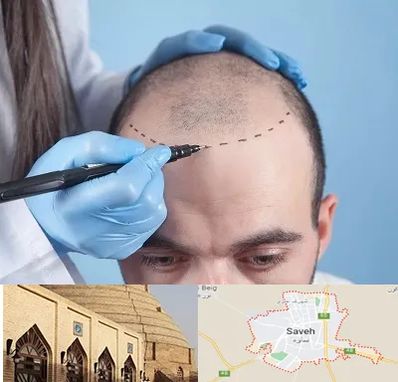 کاشت مو اقساطی در ساوه