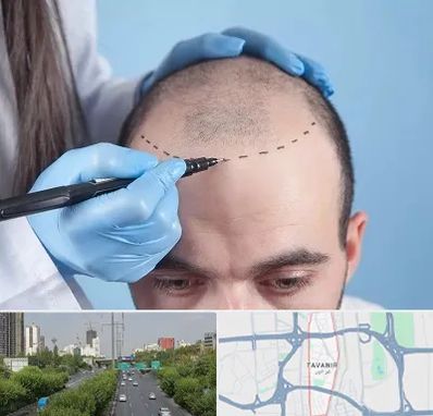 کاشت مو اقساطی در توانیر