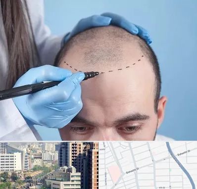 کاشت مو اقساطی در خیابان بهشتی