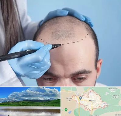 کاشت مو اقساطی در مرند