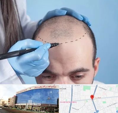 کاشت مو اقساطی در نصف راه تبریز