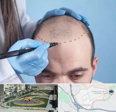 کاشت مو اقساطی در مرزداران تبریز