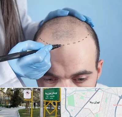 کاشت مو اقساطی در تهران ویلا