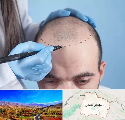 کاشت مو اقساطی در خراسان شمالی