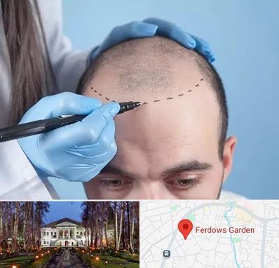 کاشت مو اقساطی در باغ فردوس