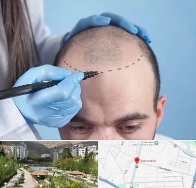 کاشت مو اقساطی در بلوار تعاون