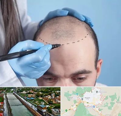 کاشت مو اقساطی در مراغه