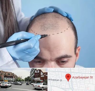 کاشت مو اقساطی در خیابان آذربایجان