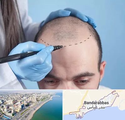 کاشت مو اقساطی در بندرعباس