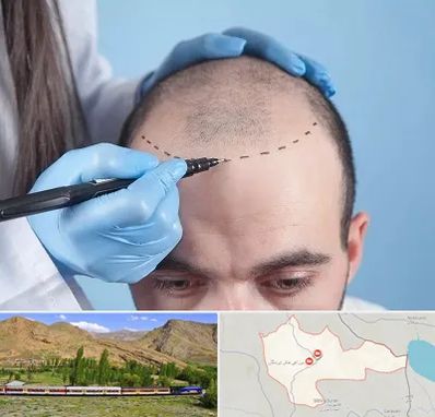 کاشت مو اقساطی در خاش