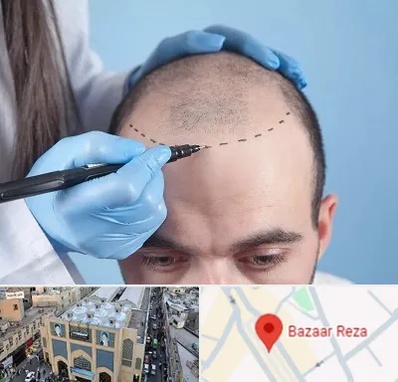 کاشت مو اقساطی در بازار رضا مشهد